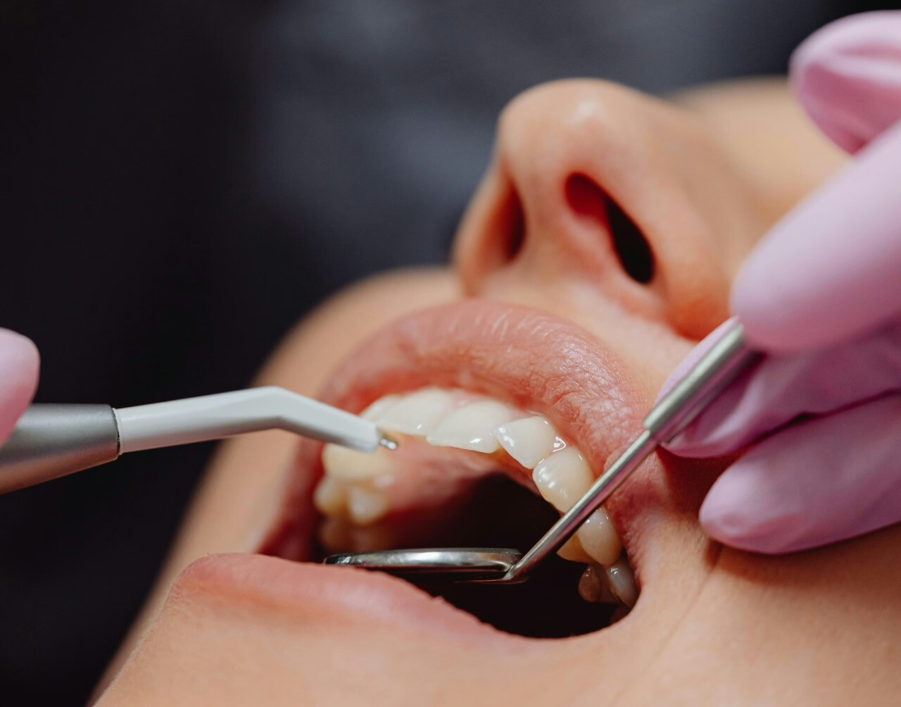 Teeth Cleaning and Other Dental Services Covered by BPJS