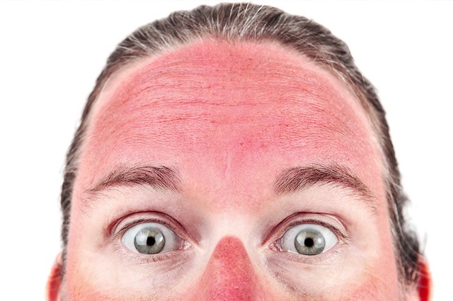 How to treat sunburn?