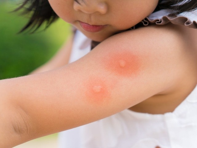 Insect bites in Bali