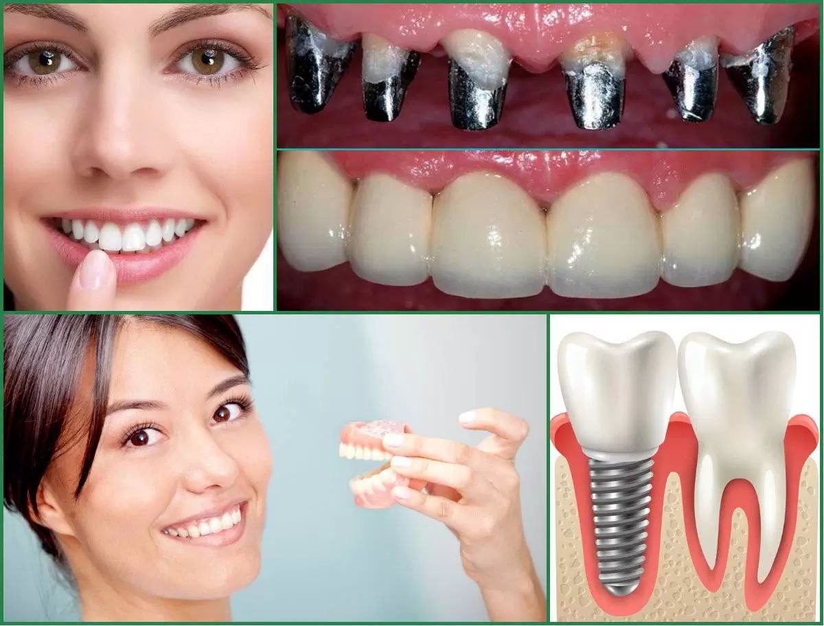 Installation Of Dental Implants In Bali. Where To Place Implants?